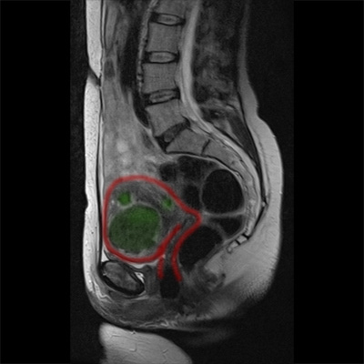 Obrazy MRT przed leczeniem